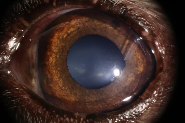 녹내장 - 밸브삽입술 치료 후