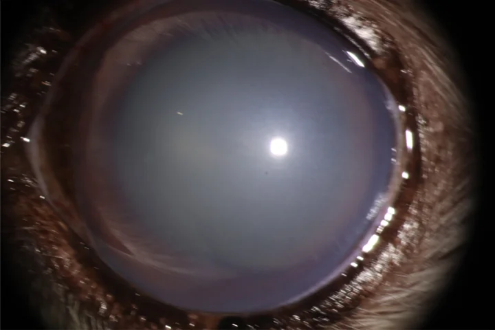 녹내장 - 밸브삽입술 치료 전