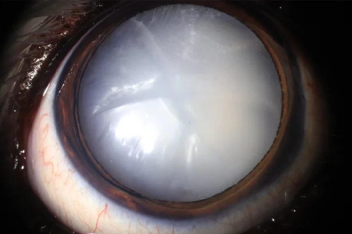 백내장 치료 전