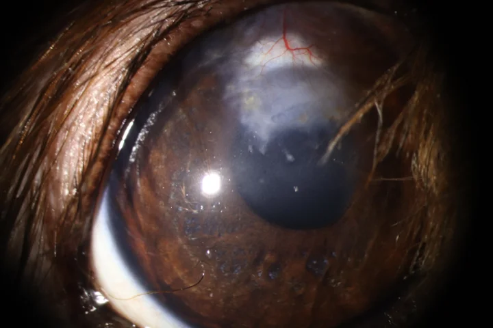 깊은 각막 궤양 결막이식술 치료 후