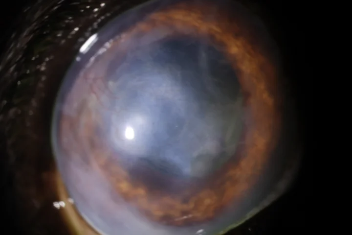 녹내장 - 모양체파괴주사 치료 후