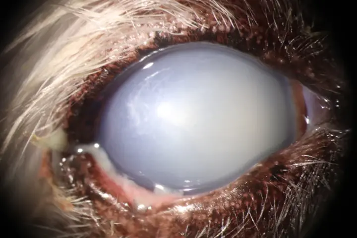 수정체 탈구 치료 전