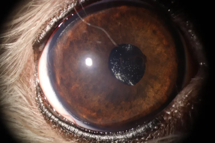 수정체 탈구 치료 후