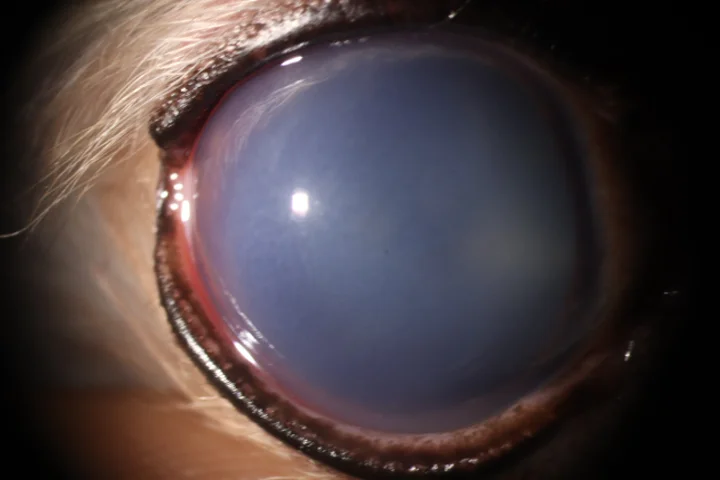 수정체 탈구 치료 전