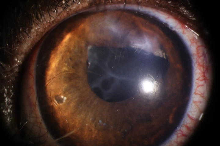 깊은 각막 궤양-안구 관통상 치료 후