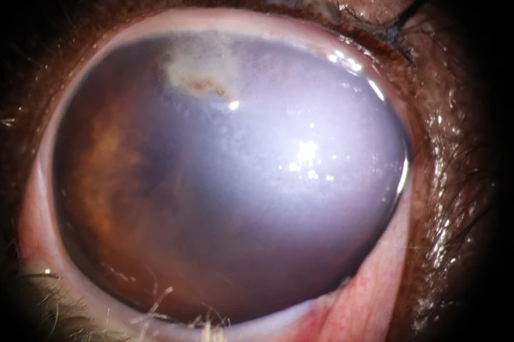 깊은 각막 궤양-안구 관통상 치료 전