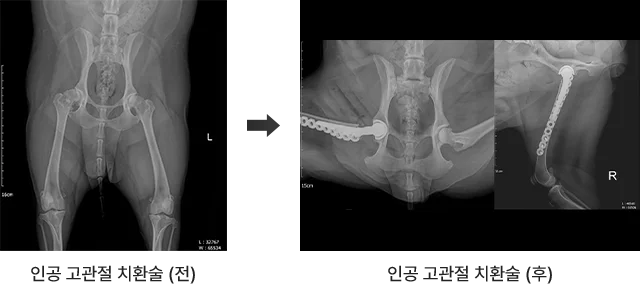 인공고관절치환술 전후 비교 사진